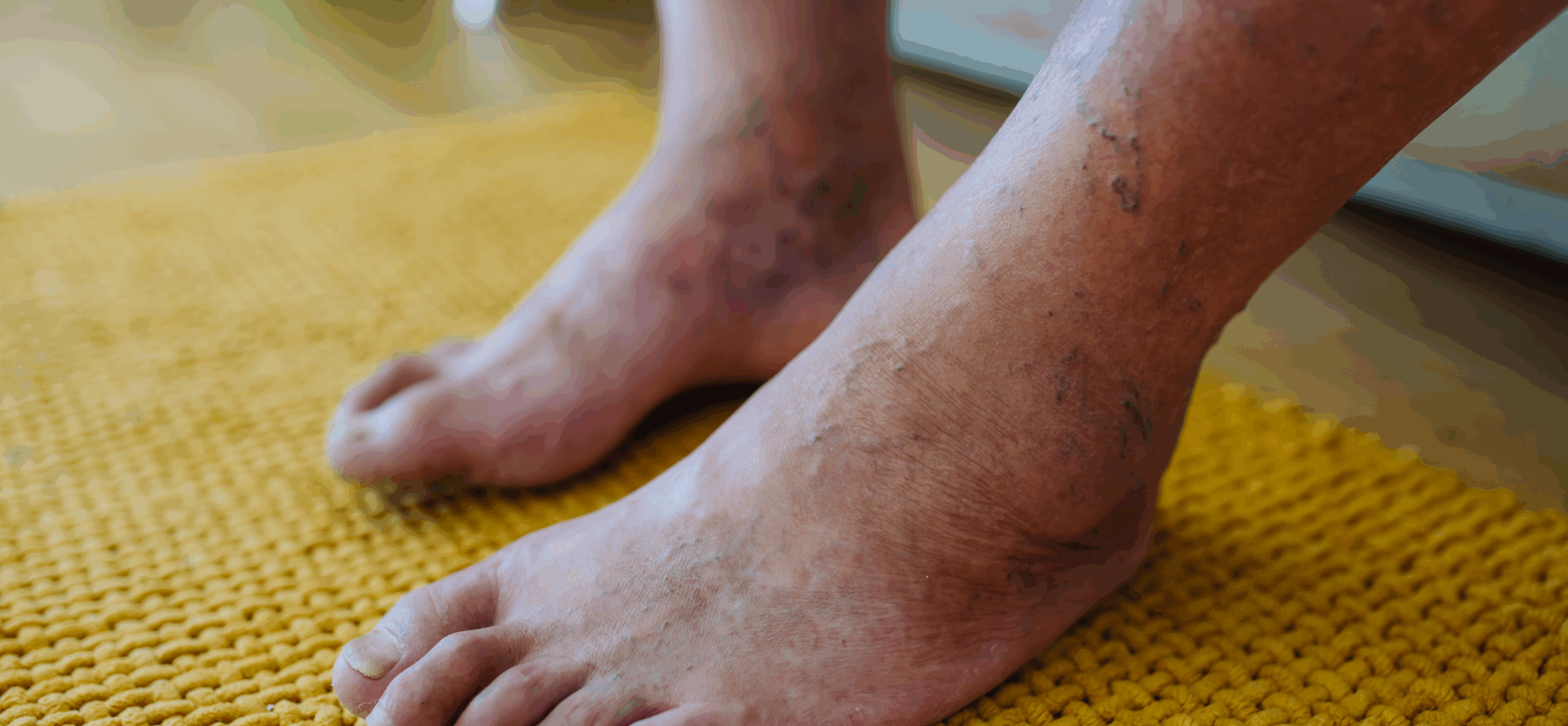 Amputation Prevention Care